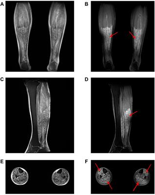 Case Report: Rhabdomyolysis secondary to vildagliptin overdose in a suicidal attempt: A case report and brief literature review